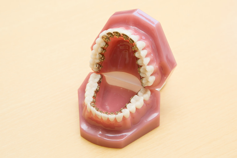 東川口駅で見えない矯正 裏側矯正 マウスピース矯正